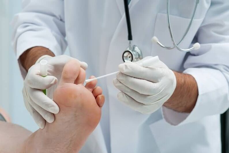 Ak máte príznaky plesní nechtov na nohách, mali by ste sa poradiť s dermatológom alebo mykológom. 